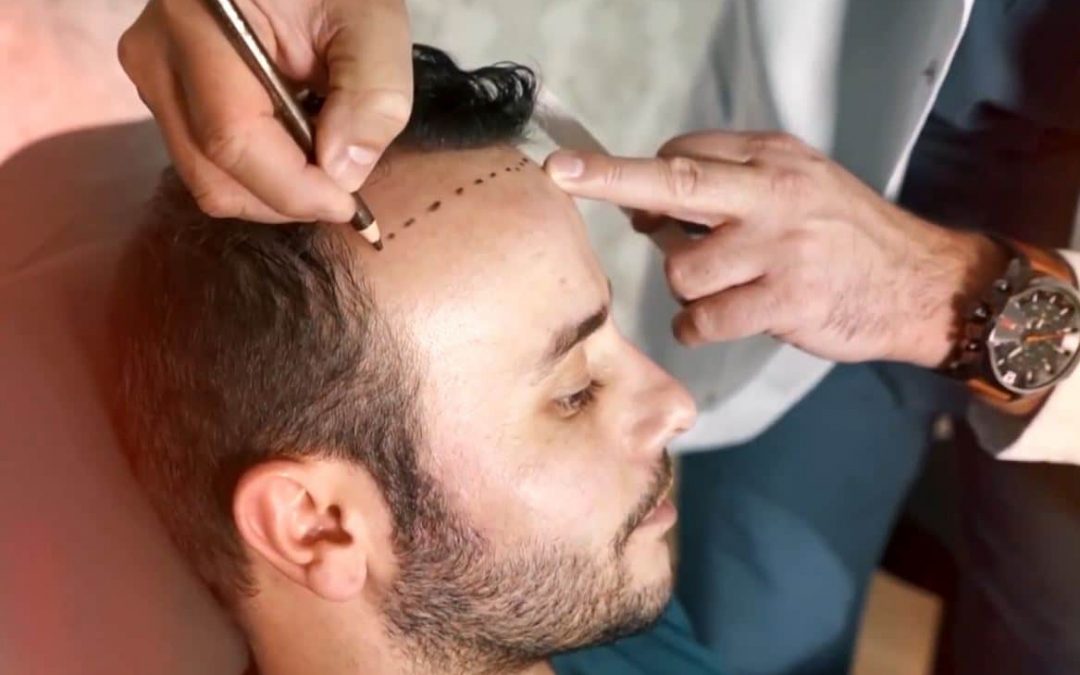 7 faits à retenir sur la greffe de cheveux FUE