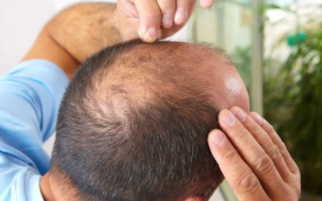 12 conseils pour préserver ses cheveux après une greffe de cheveux