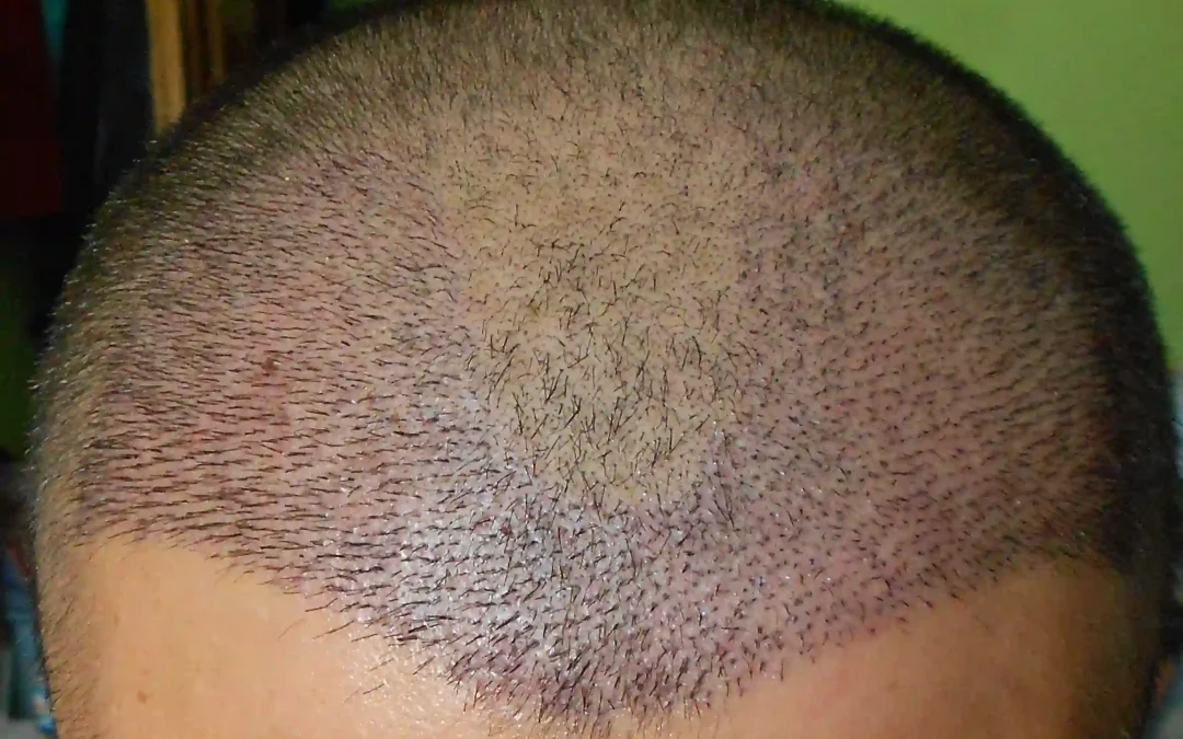 Le guide ultime de la greffe de cheveux Turquie