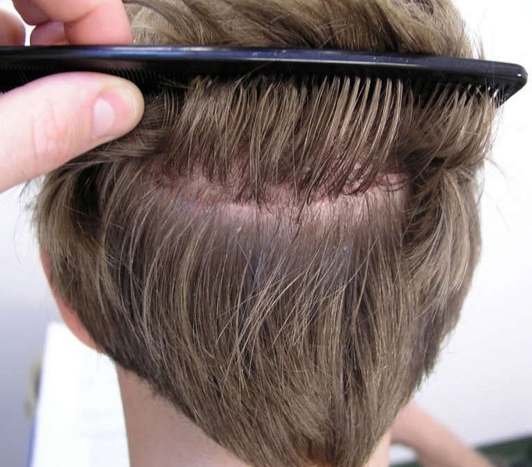 Quel est l’âge idéal pour effectuer une greffe de cheveux?