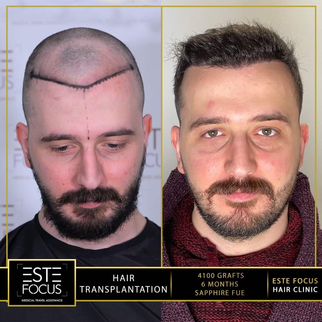 avant et  après greffe de cheveux