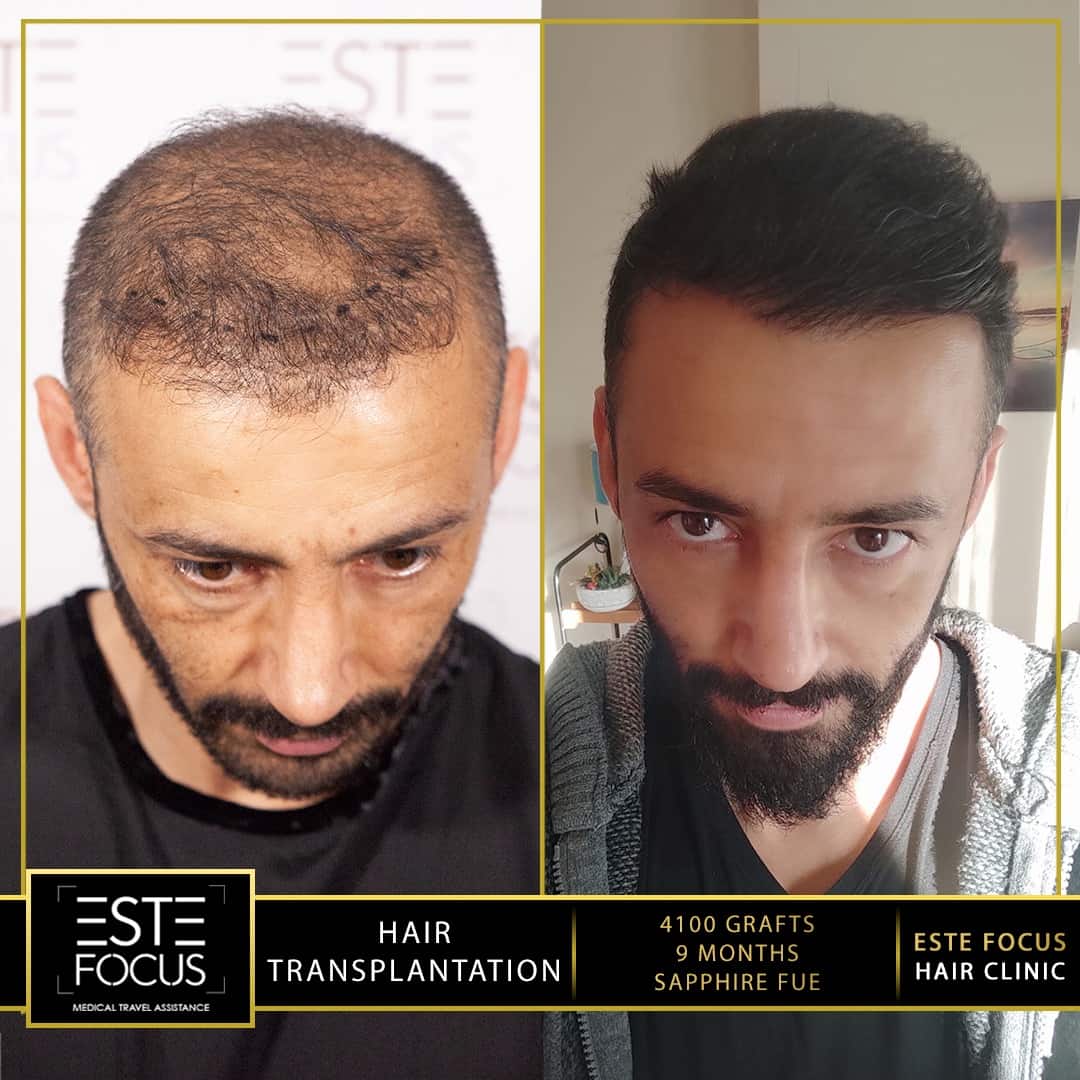 avant et  après greffe de cheveux