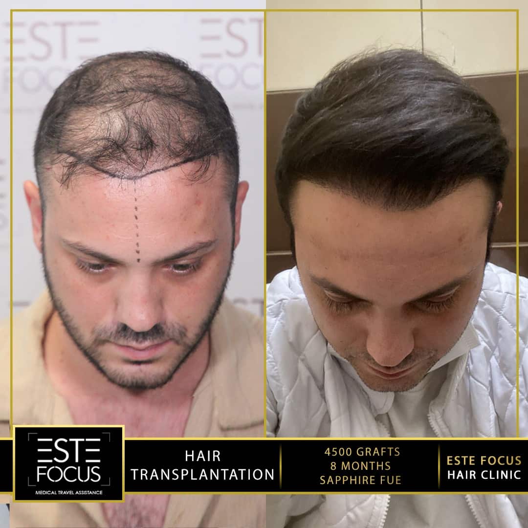 avant et  après greffe de cheveux